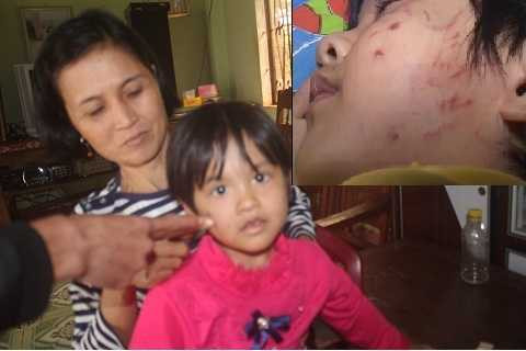 Vết thương trên mặt bé Vy.Ảnh:Thanh Hải