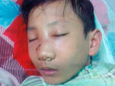 Cháu Hạnh khi đang điều trị “sai khớp sụn vách mũi” ở bệnh viện (ảnh do gia đình nạn nhân cung cấp). Cháu Hạnh khi đang điều trị “sai khớp sụn vách mũi” ở bệnh viện (ảnh do gia đình nạn nhân cung cấp).