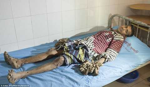 Abul đã sống chung cùng căn bệnh này 7 năm