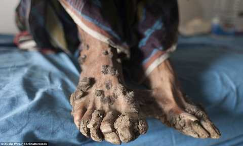 Mụn cóc mọc khắp tay chân của Abul