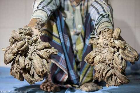 Các ngón tay của anh Abul bị biến dạng