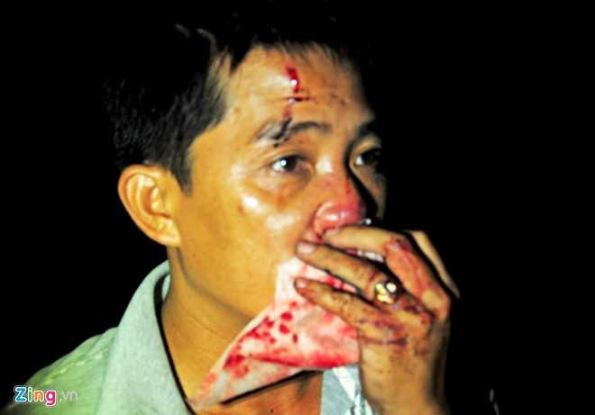 Tài xế xe khách Nguyễn Trọng Quỳnh (ngụ huyện Đakrong, tỉnh Quảng Trị) bị thương nặng ở mặt. Do mất lái, xe của tôi lao xuống vực, vô lăng đập mạnh vào mặt gây chảy máu mũi, trầy xước vùng trán. Tôi đã dùng búa thoát hiểm cùng người dân phá kính đưa mọi người thoát ra ngoài, ông Quỳnh cho hay. 