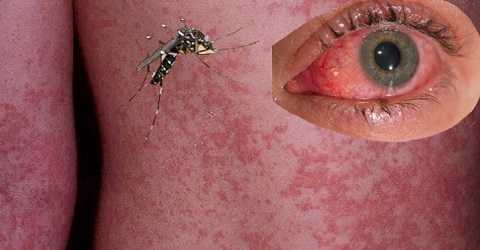 Vi rút Zika gây bệnh đầu nhỏ nguy hiểm, chưa có vắc xin phòng bệnh.