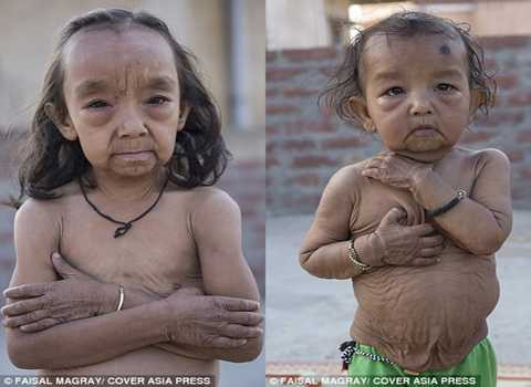Bé Keshav Kumar (trái) và chị Anjali Kumari đều mắc căn bệnh lạ. Ảnh Daily Mail Bé Keshav Kumar (trái) và chị Anjali Kumari đều mắc căn bệnh lạ. Ảnh Daily Mail
