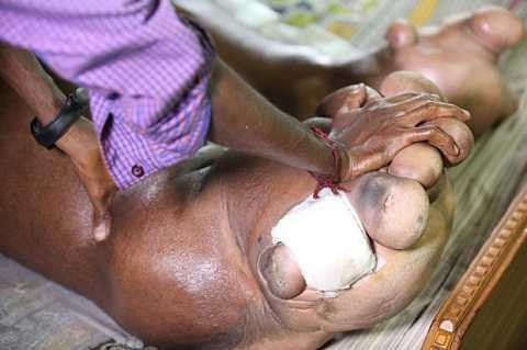 Đôi chân cồng kềnh khiến Arun khó có thể di chuyển