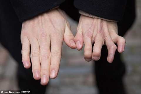 Bàn tay mới được thay thế của Richard