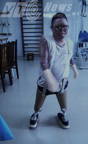 Anh Dương đã có thể tự đi lại được trên đôi chân của mình