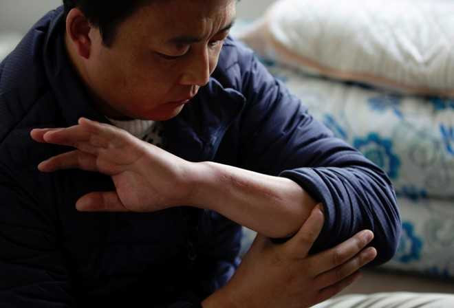 Zhang Wenkun chỉ vết sẹo trên tay vì bị thương trong khi làm việc. Ảnh: Bloomberg