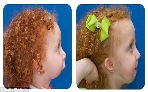 Từ khi sinh ra Lexi đã không có xương hàm dưới và phải trải 11 ca phẫu thuật Từ khi sinh ra Lexi đã không có xương hàm dưới và phải trải 11 ca phẫu thuật