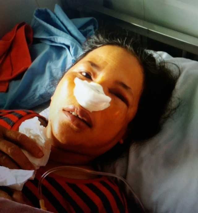 Chị Bình bị nhân viên ban quản lý chợ hành hung gãy sống mũi phải nhập viện cấp cứu.