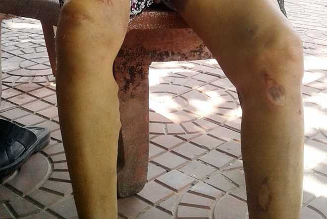 Nạn nhân bị thương ở chân