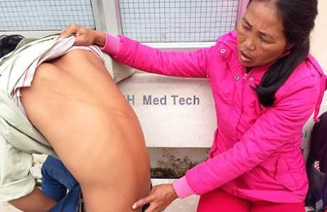 Dù đã qua nhiều ngày điều trị nhưng trên lưng của Hiếu vẫn còn nhiều vết sưng bầm chạy dài. Ảnh: KIỀU ANH