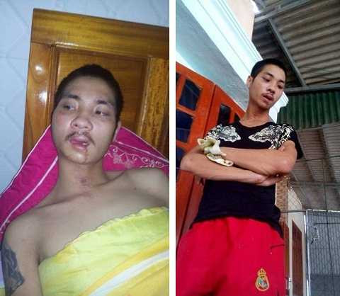 Vũ bị chấn thương sọ não và đa chấn thương nên mất trí nhớ, sức khỏe yếu Vũ bị chấn thương sọ não và đa chấn thương nên mất trí nhớ, sức khỏe yếu