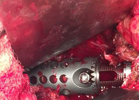 Đốt sống nhân tạo được thay cho bệnh nhân. Đốt sống nhân tạo được thay cho bệnh nhân.