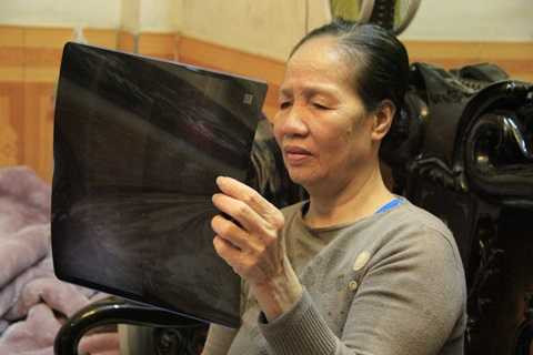 Kết quả kiểm tra cho biết, bà Lợi bị rạn 2 đốt xương sống ở gần xương cụ