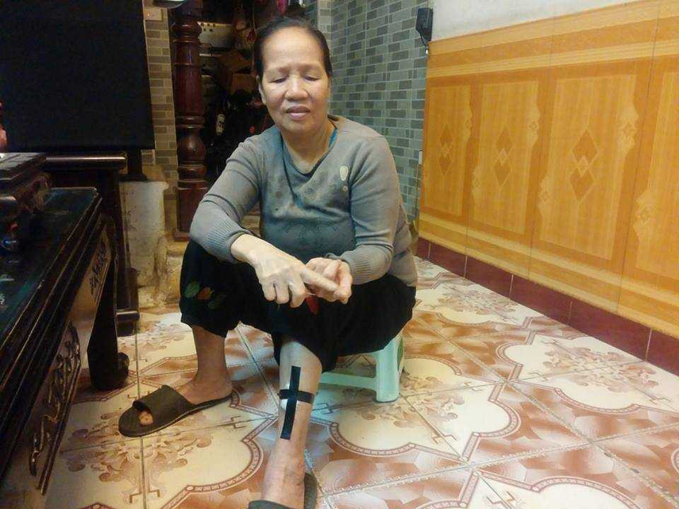 Bà Lợi kể phút kinh hoàng khi bị đàn chó tấn công