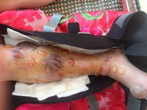 Vết thương em Hà Vi sau khi tháo bột tại bệnh viện huyện Cư Kuin Vết thương em Hà Vi sau khi tháo bột tại bệnh viện huyện Cư Kuin