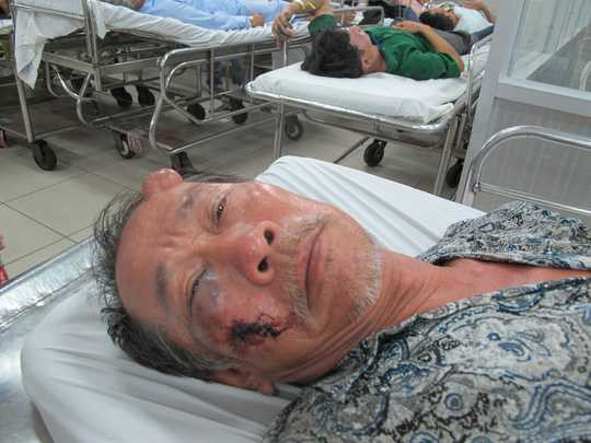 Ông Đại bị đánh bầm mắt, chấn thương đầu và vai