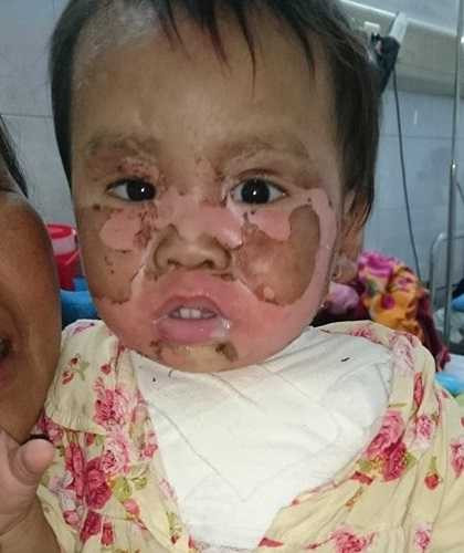 Nghẹn lòng mẹ ung thư khao khát được chăm sóc con bị nước sôi dội vào người