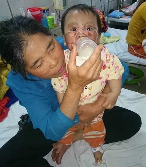 Nam trong ngày điều trị thứ 3 (Ảnh: Facebook Children First) Nam trong ngày điều trị thứ 3 (Ảnh: Facebook Children First)