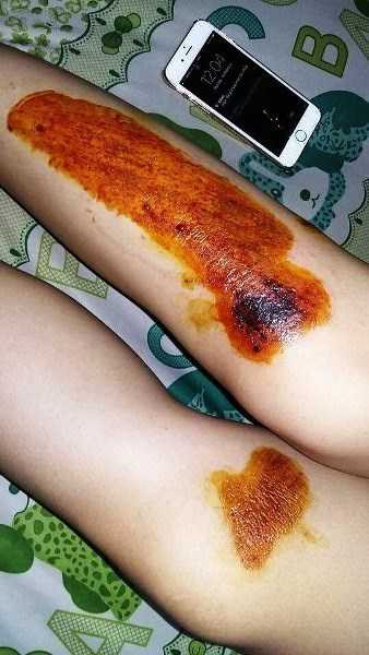 Tố Ny bị trầy xước 2 chân khi bị cướp giật.