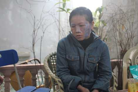 Chị Hồng với vết thương khắp mặt do bị chồng bạo hành