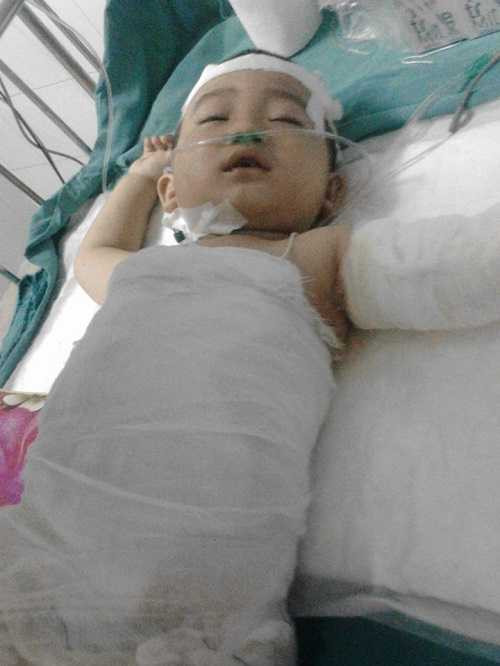 Giờ cháu đang được các bác sĩ tiêm thuốc ngủ để đỡ đi phần nào cơn đau do vết bỏng gây ra