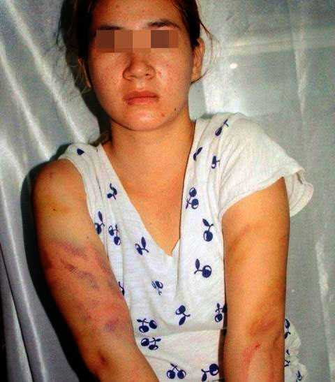 Chị Mơ với những vết thương do Pháp đánh.