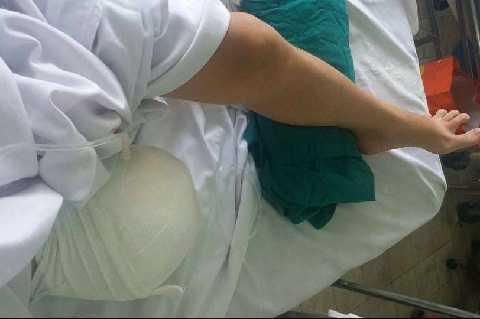 Hình ảnh chân phải bị cắt của Hà Vi tại bệnh viện Chợ Rẫy Hình ảnh chân phải bị cắt của Hà Vi tại bệnh viện Chợ Rẫy