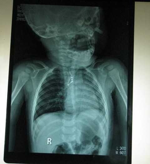 Sau khi chụp Xquang, các bác sỹ đã phát hiện ra một tụ điện trở kim loại trong phế quản cháu bé. Sau khi chụp Xquang, các bác sỹ đã phát hiện ra một tụ điện trở kim loại trong phế quản cháu bé.