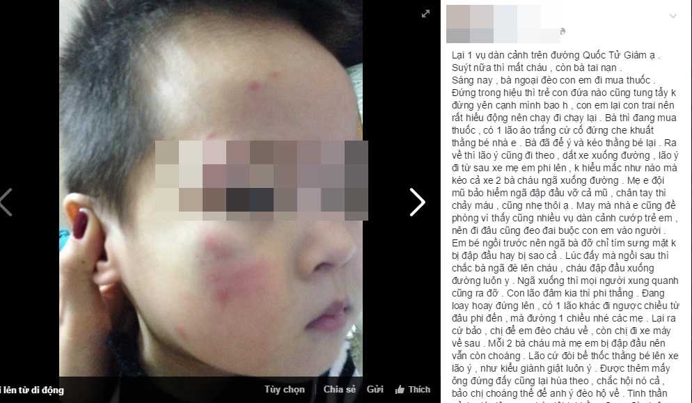 Ảnh con bị té sưng mặt và status tố một số đối tượng dàn dựng cảnh để bắt cốc con mình 