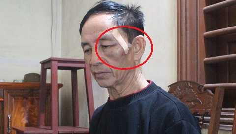 Sáng 25/3, vùng mặt ông Sửu vẫn bị thâm đen và cảy do bị đấm Sáng 25/3, vùng mặt ông Sửu vẫn bị thâm đen và cảy do bị đấm