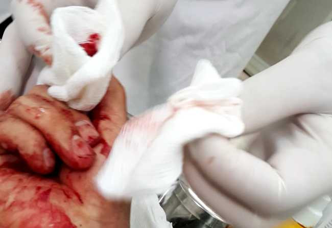 Ngoài việc bị đánh bầm dập ở tay, anh Hoàng còn bị nhiều chỗ khác