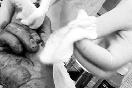 Vết thương trên ngón tay phải của nhà báo Hoàng - Nguồn ảnh: Zing