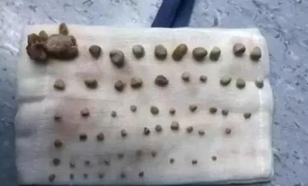 Bé trai 9 tuổi có 56 viên sỏi trong thận vì thói quen ăn thịt mỗi ngày