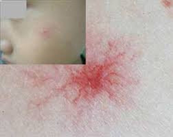 4 tín hiệu này xuất hiện trên mặt, báo hiệu ung thư gan cận kề