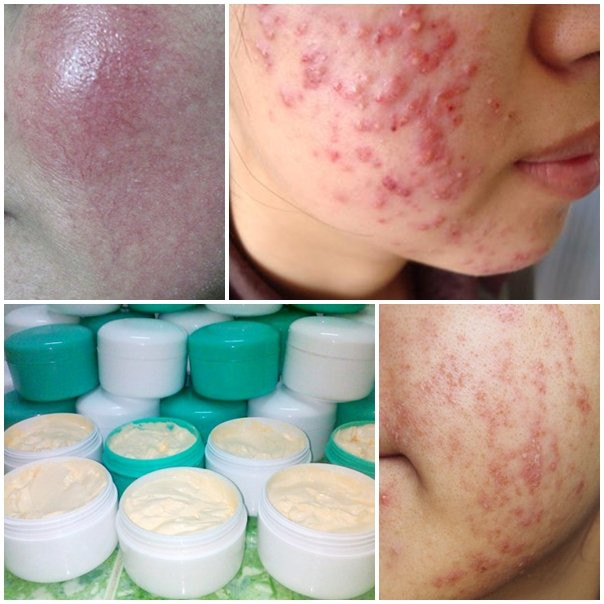 Sau khi đọc xong bài viết này, chị em sẽ không dám sử dụng kem trộn trắng da nữa