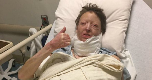 Ngưỡng mộ nghị lực phi thường của người phụ nữ bị chồng bỏ do bỏng xăng biến dạng