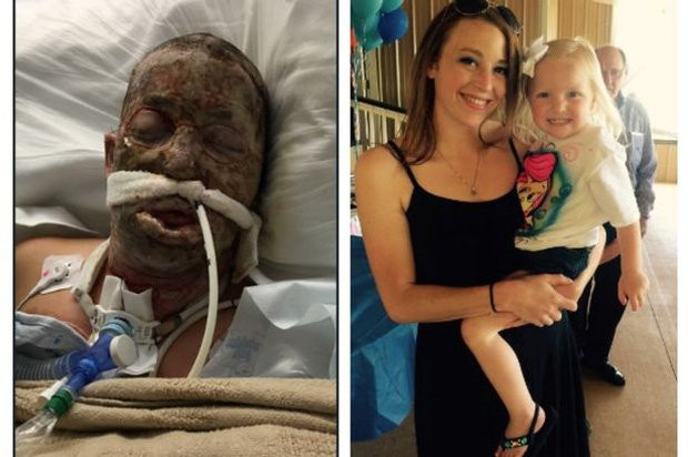 Ngưỡng mộ nghị lực phi thường của người phụ nữ bị chồng bỏ do bỏng xăng biến dạng