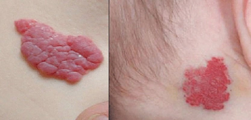 Thấy vết bớt đỏ tưởng nốt ruồi son, mẹ ngã ngửa khi biết đó là trọng bệnh