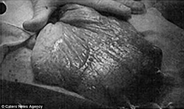 Mang thai 6 tuần nhưng bụng to như 8 tháng, người mẹ sốc nặng khi biết mình mang trọng bệnh