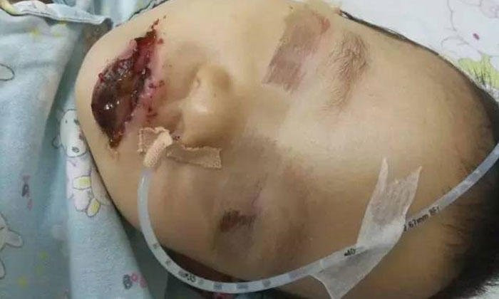 Ăn nhầm bột giặt vì tưởng là sữa, em bé bị bỏng nghiêm trọng