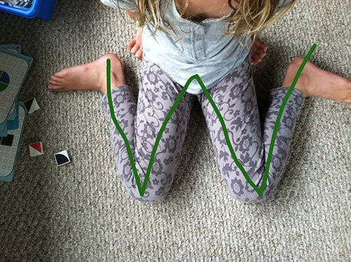 Chân con bị vòng kiềng: Có phải do mẹ không biết nắn chân?