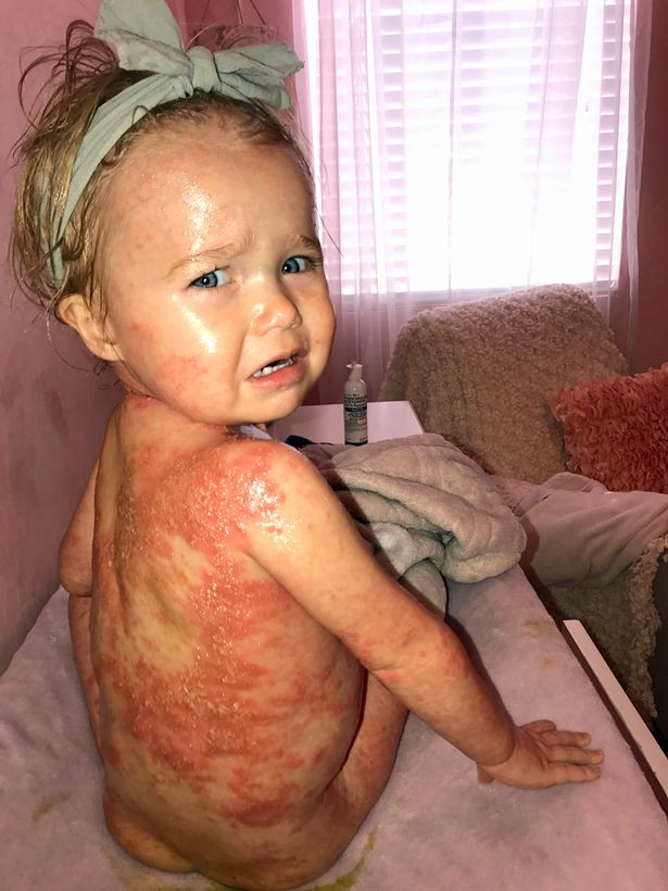 Em bé 20 tháng tuổi mắc căn bệnh đáng sợ khiến toàn thân phồng rộp, bong tróc