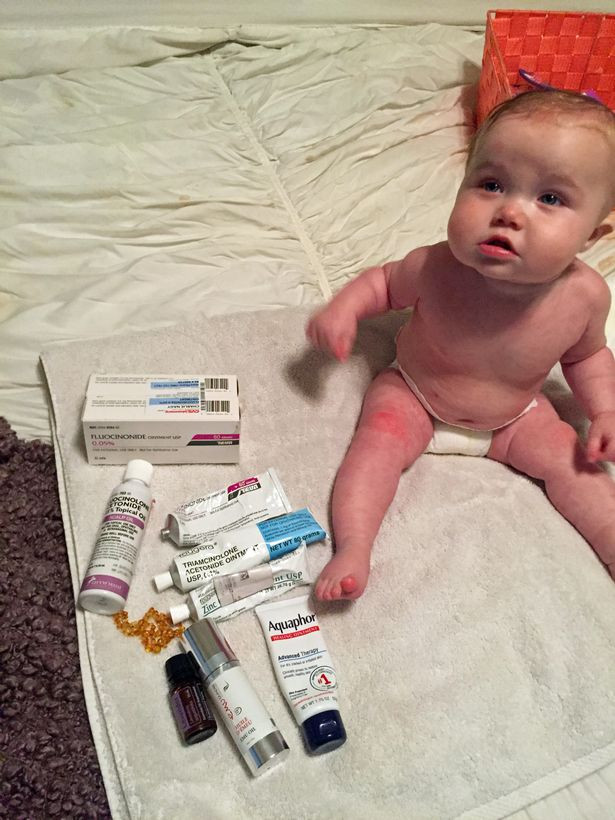 Em bé 20 tháng tuổi mắc căn bệnh đáng sợ khiến toàn thân phồng rộp, bong tróc