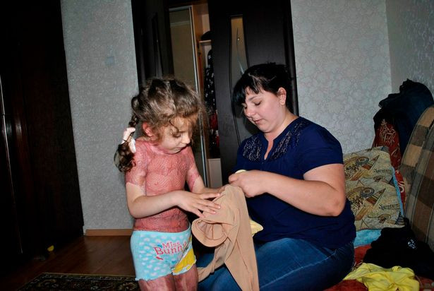 Bé gái 5 tuổi bị đốt cháy kinh hoàng vì mơ trở thành 'nàng tiên lửa' giống trên mạng