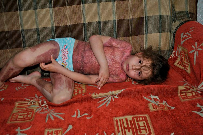 Bé gái 5 tuổi bị đốt cháy kinh hoàng vì mơ trở thành 'nàng tiên lửa' giống trên mạng