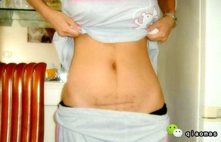 Tận mắt chứng kiến ca sinh mổ chân thật đến từng chi tiết mà mẹ nào cũng nên xem