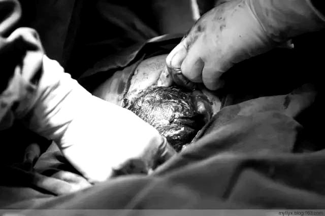 Tận mắt chứng kiến ca sinh mổ chân thật đến từng chi tiết mà mẹ nào cũng nên xem