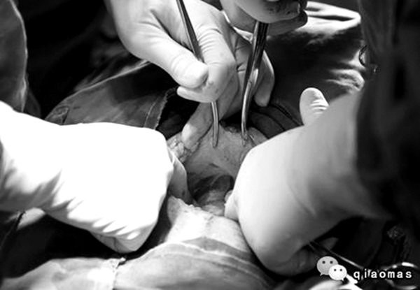 Tận mắt chứng kiến ca sinh mổ chân thật đến từng chi tiết mà mẹ nào cũng nên xem